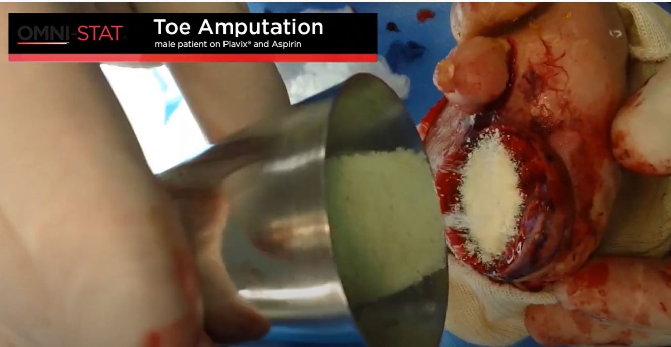 Toe Amputation Bleeding Control in Surgery