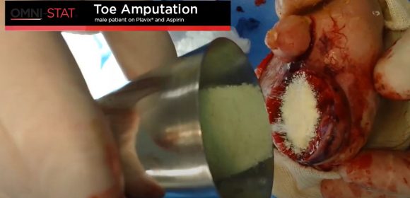 Toe Amputation Bleeding Control in Surgery