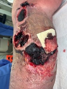 Hematoma with Hemostatic Gauze