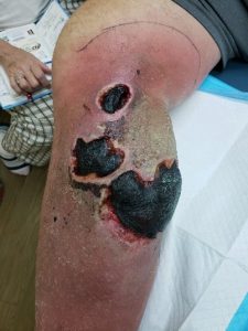 Hematoma before debridement