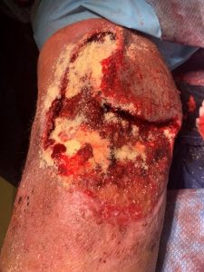 Hematoma after Debridement