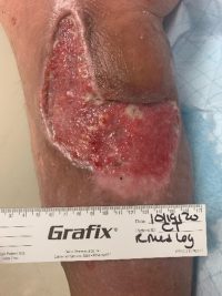 Hematoma debridement 9 days post surgery