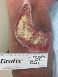 Hematoma after further debridement showing hemostat granules