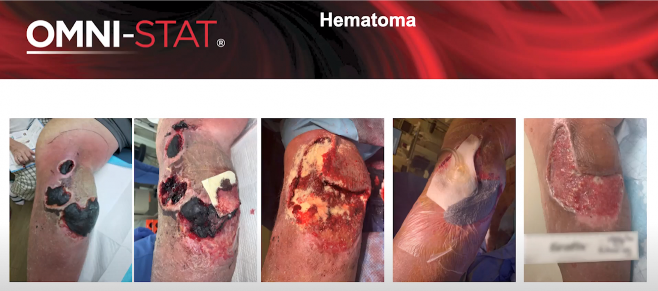 Hematoma Debridement : Case Study Update – Fully Healed Wound