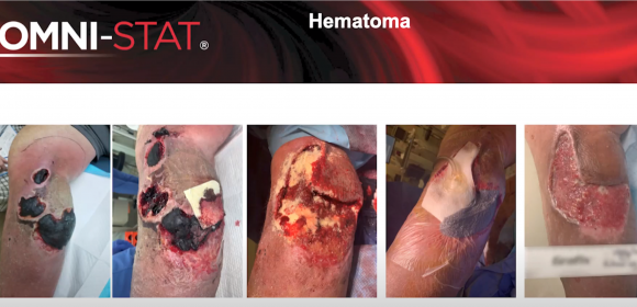 Hematoma debridement