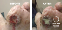 Diabetic Foot Ulcer