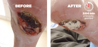 Necrotic Tendon Diabetic on Dialysis