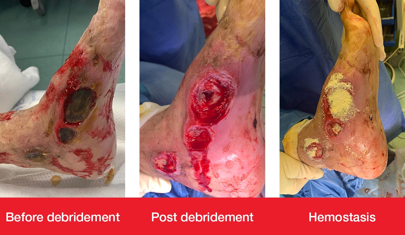 Sharp Debridement