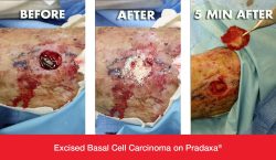 MOHs Surgery